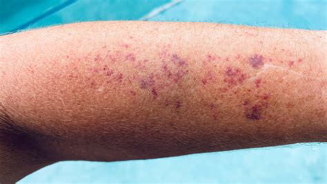 doença purpura - sintomas de doença celíaca